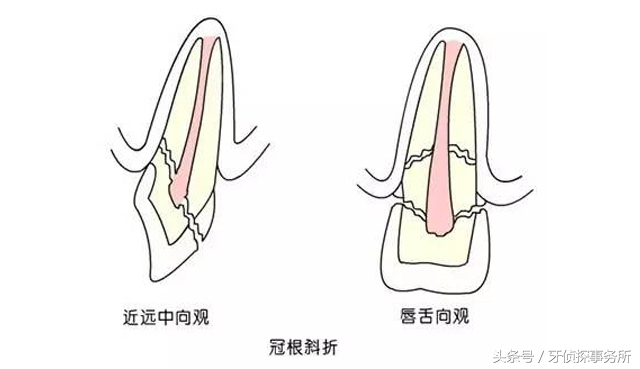 用了舒客牙膏牙齿对冷热敏感,牙齿敏感松动用什么牙膏最好