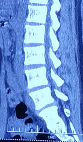 美女们，我该如何去拯救你们椎间盘突出的腰？
