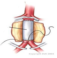 腹主动脉瘤的中医诊断,腹主动脉瘤手术费用是多少