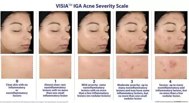 油痘皮的惨痛分享,痘坑血泪史