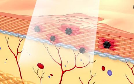 果酸换肤美白效果,果酸换肤和m22光子嫩肤哪个先做