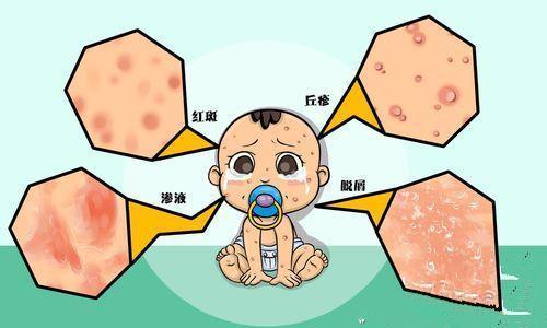 宝宝湿疹怎么预防最佳方法,婴儿湿疹怎么办三个妙招来解决