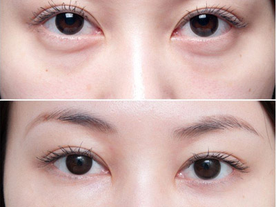 眼袋手术彻底去眼袋,去眼袋手术改善眼角纹吗