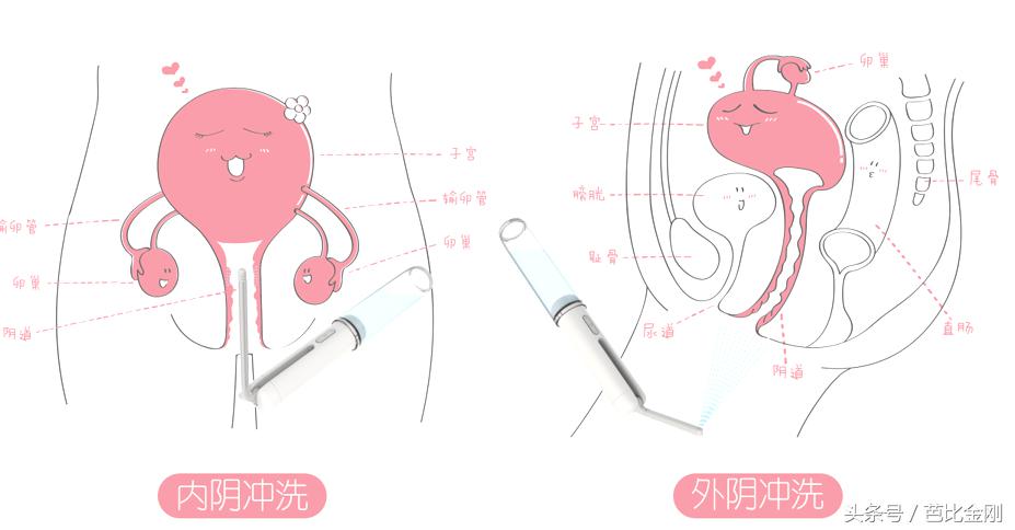 蹲坑时间太久是痔疮的罪魁祸首吗,蹲坑时间长容易得痔疮