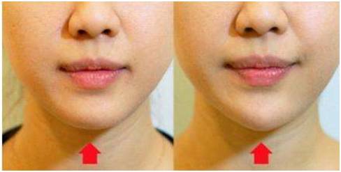 玻尿酸是瘦脸还是填充,玻尿酸填充脸颊会有提拉效果吗