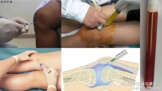 滑膜炎的治疗与预防（二）——华中科技大学附属协和骨科医院专家