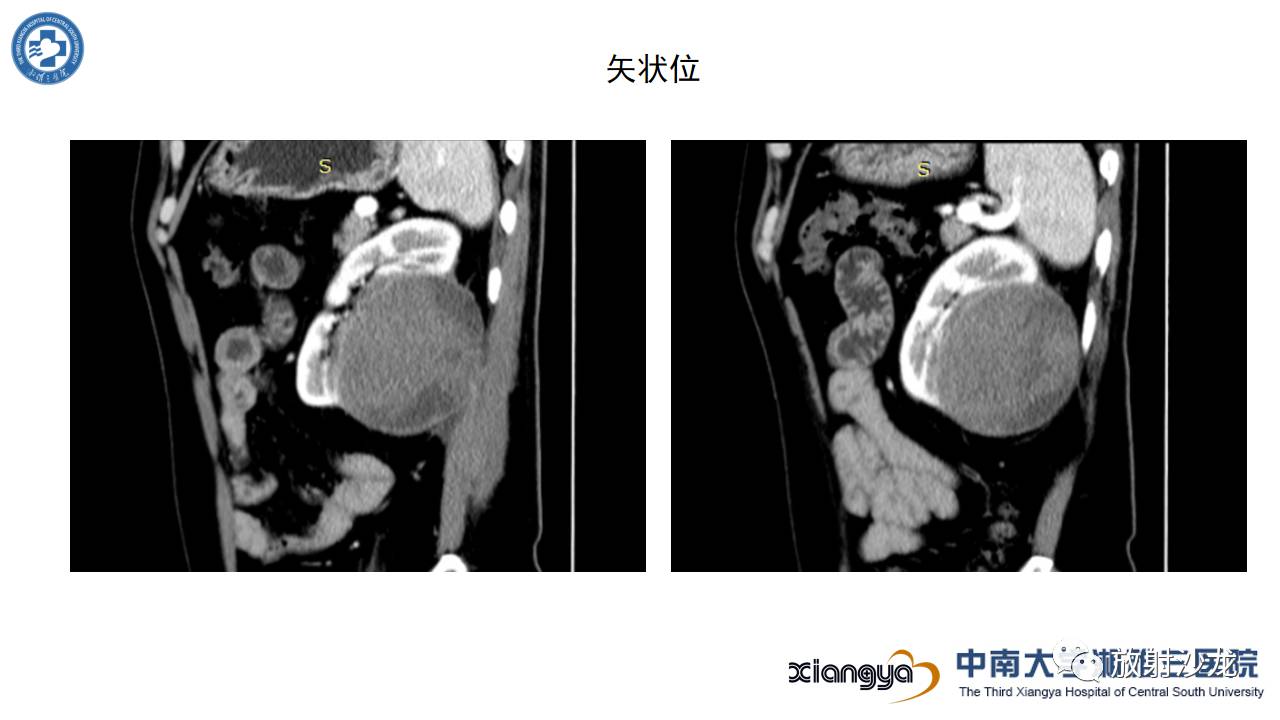 左腰侧边撞伤里面隐隐作痛,左腰被撞现在肚子痛