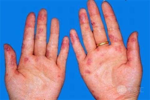 有关系统性红斑狼疮的疑问,系统性红斑狼疮症状的问诊