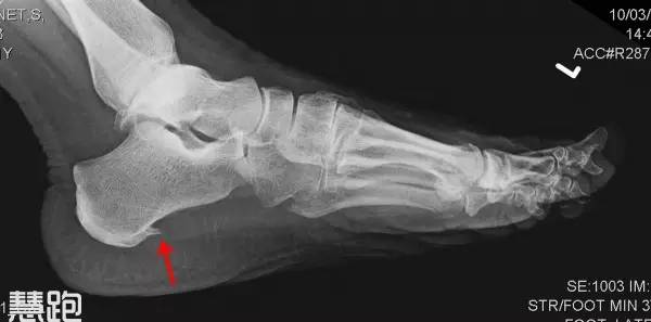 全球治好足跟痛,足底疗法治百病