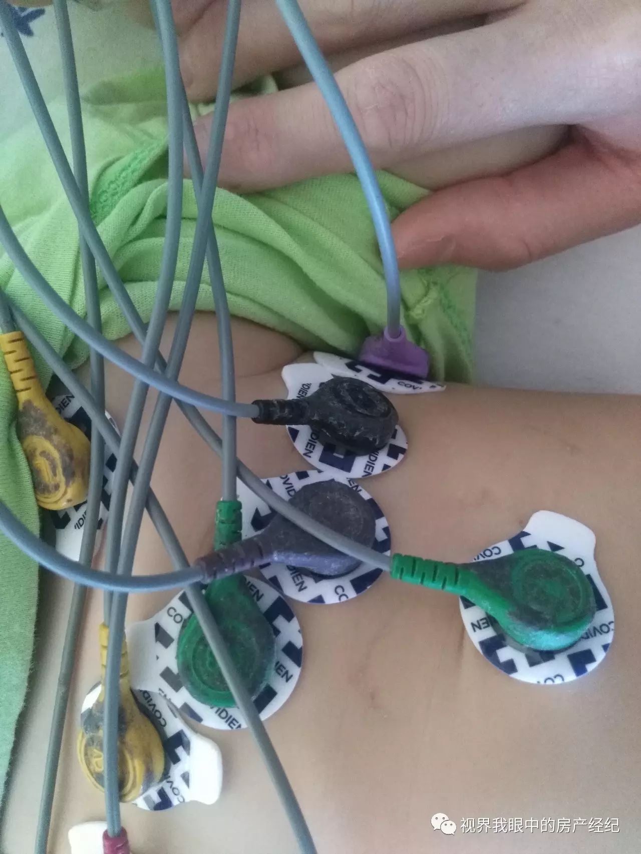 川崎病恢复期怎么预防感冒,川崎病当成感冒会出什么问题