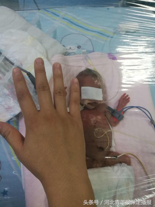 保定新生婴儿出生,生长受限的早产儿刚出生的照片