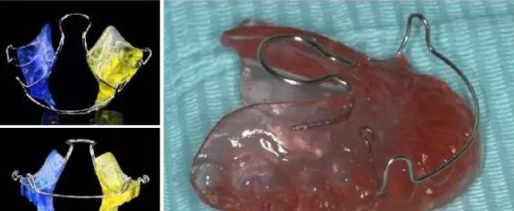 正颌手术后下颌后缩严重,医生下颚线真的可以锻炼出来吗