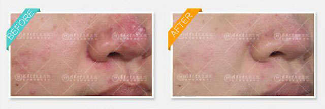 青春痘有什么方法解决,青春期已经长痘了怎么改善皮肤