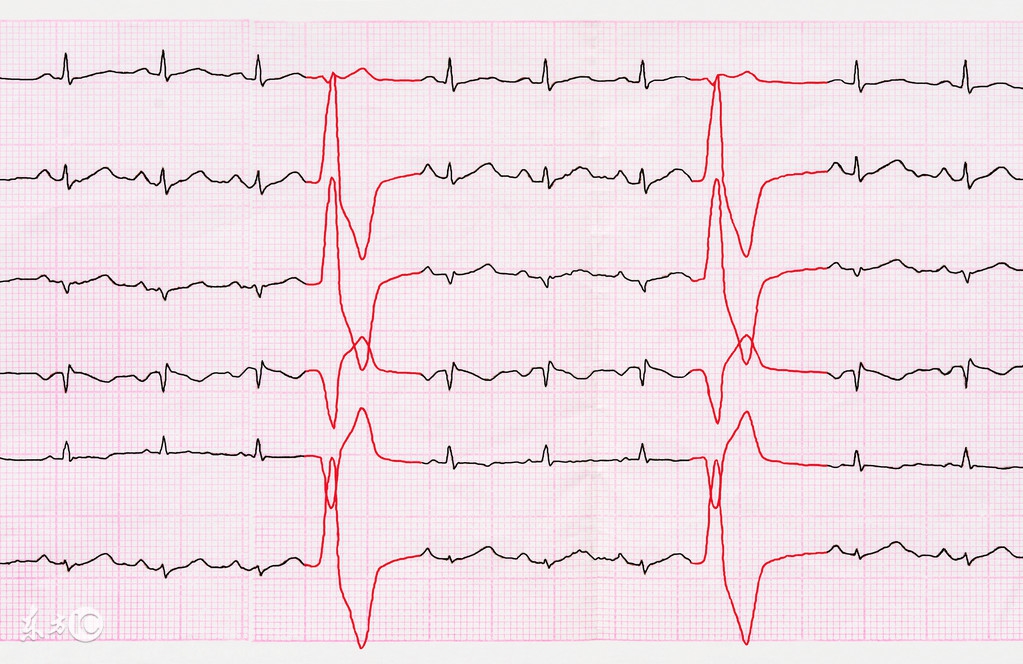 心脏早搏应怎么注意保养,心脏早搏日常有哪些注意事项