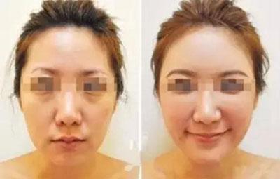 自体脂肪填充会下垂和移位吗,自体脂肪填充脸部后会自己消失吗