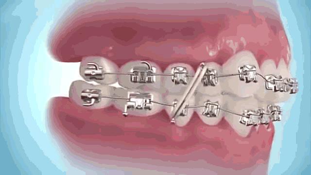 戴牙套牙齿会松动嘛,戴牙套牙齿会往里凹嘛