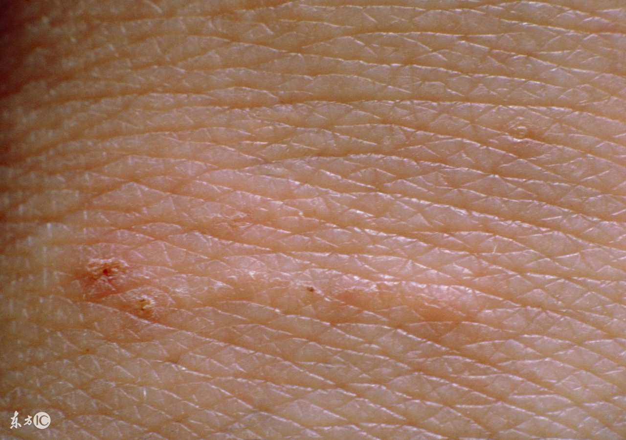 草鱼疥疮病的防治,疥疮防治意见