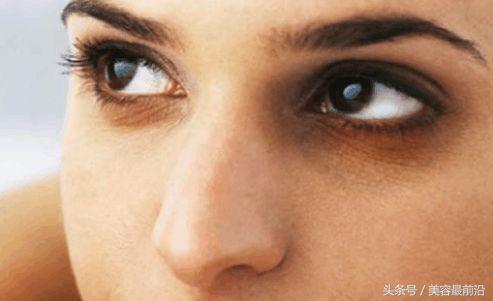 女人黑眼圈太重怎么消除,女人黑眼圈是什么意思