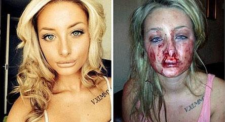 现在打架斗殴怎么解决,打架脸肿起来大包怎么办