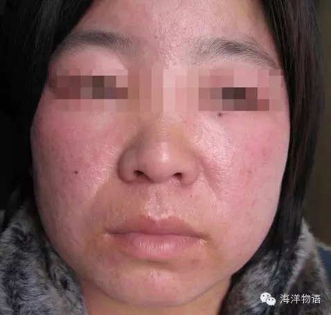 皮肤红痒刺痛用什么药膏,皮肤红刺痛