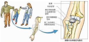 小儿桡骨半脱位的症状,小儿桡骨半脱位临床表现