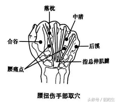 急性腰痛有几种“一针疗法”？