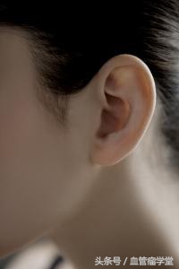 耳部也长血管瘤？4种分型的危害及治疗一篇读懂