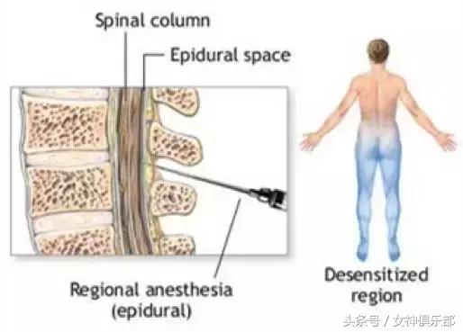 无痛分娩后期会腰痛吗,无痛分娩后期有危险吗