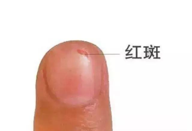 指甲出现哪些症状是有问题的,指甲上有皱纹有什么信号求救