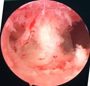 「又是“人流”惹的祸」发生子宫粘连怎么破？