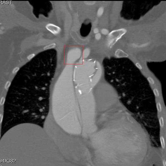 主动脉夹层早期征兆35岁,主动脉夹层早期征兆心率