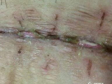 产妇剖宫产伤口化脓,剖宫产术后50天黄色恶露