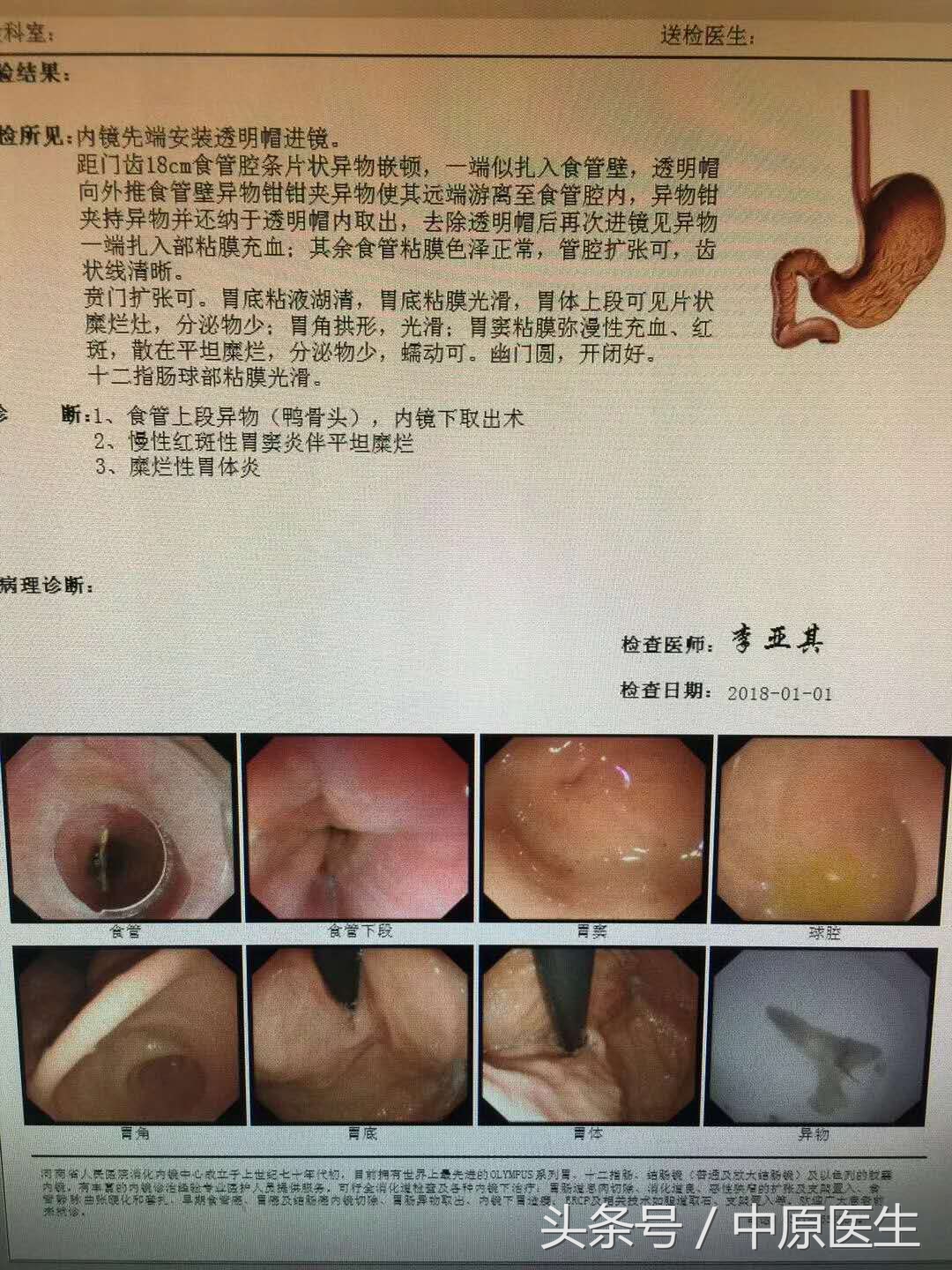 吃东西不小心被卡怎么办,小鱼刺卡到食管怎么办