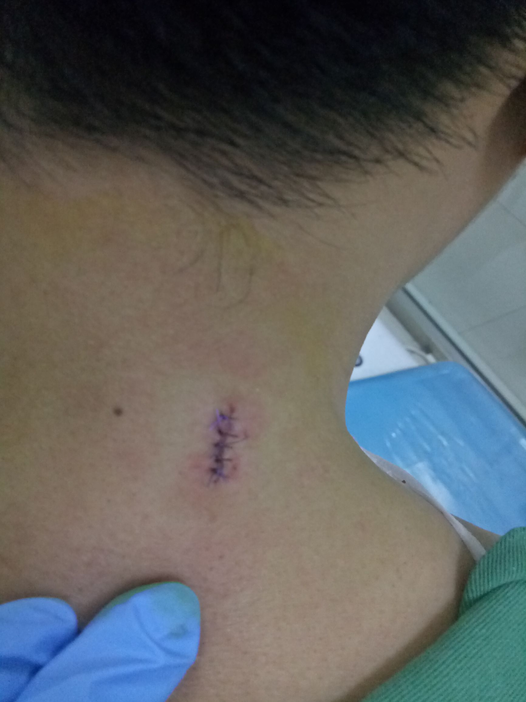 男人肩上扛着痣好吗,肩上扛痣的人是不是很苦