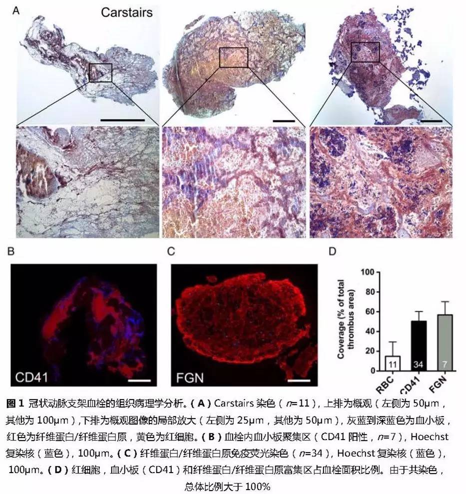 支架内血栓怎么处理,支架内血栓的原因及表现