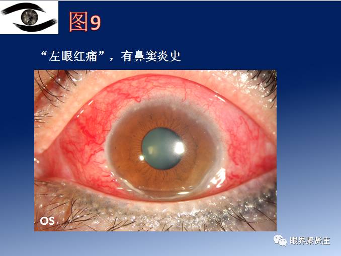 几种眼病的视野图,看图识病是什么病