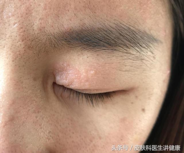 甲硝唑凝胶可以治神经性皮炎吗,神经性皮炎克林霉素甲硝唑