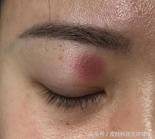 胳膊上长了皮疹是不是神经性皮炎,眼睛周围过敏性皮疹