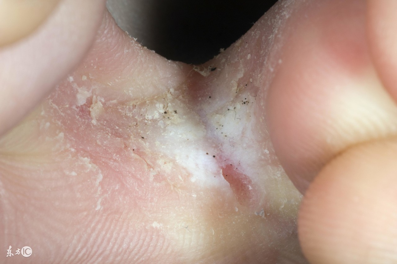 糜烂性胃窦炎饮食要注意什么,糜烂型脚气有哪些需要注意的