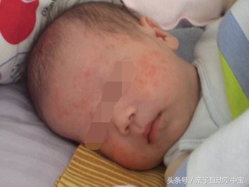 宝宝出现湿疹和拉肚子是什么原因,宝宝因为湿疹会哭闹吗