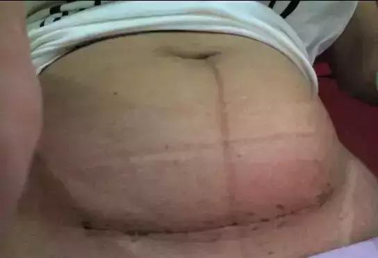 剖腹产后32天伤口出血,剖腹产后40多天伤口突然流脓