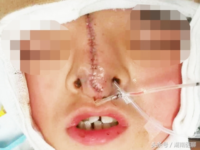 12岁小孩因长相太怪无法入学,尝试整形手术成功,父母热泪盈眶!