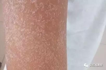 猩红热要注意什么,猩红热一般是怎么得的