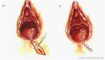 撕裂和侧切哪个好恢复,顺产侧切和撕裂哪个好恢复