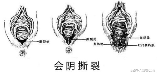 顺产是选择拆线还是不拆线好,顺产要不要选择ldr