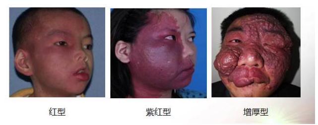 红胎记好治疗吗,红胎记好治吗