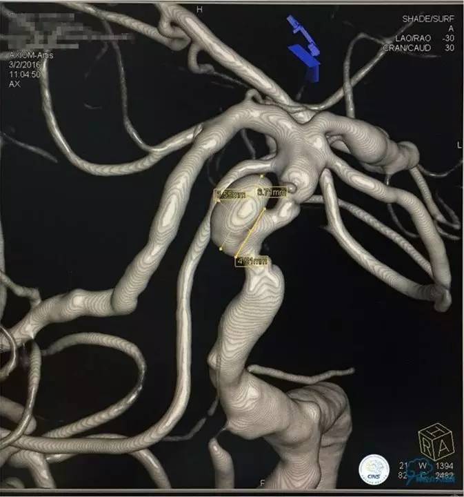 脑动脉瘤并颈动脉狭窄怎么治疗,脑动脉血管狭窄介入治疗效果好吗