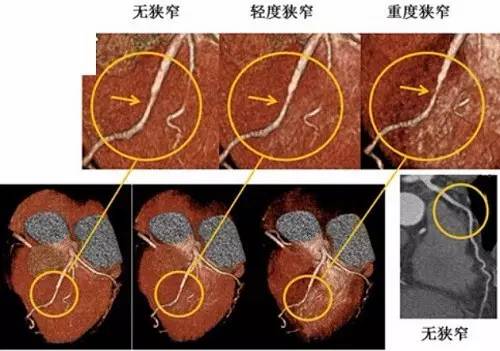 微课堂牢记三要诀，轻松看懂冠脉CTA