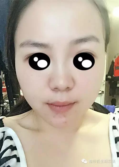 非手术的抗皱紧致怎么做,全脸紧致的方法和原理