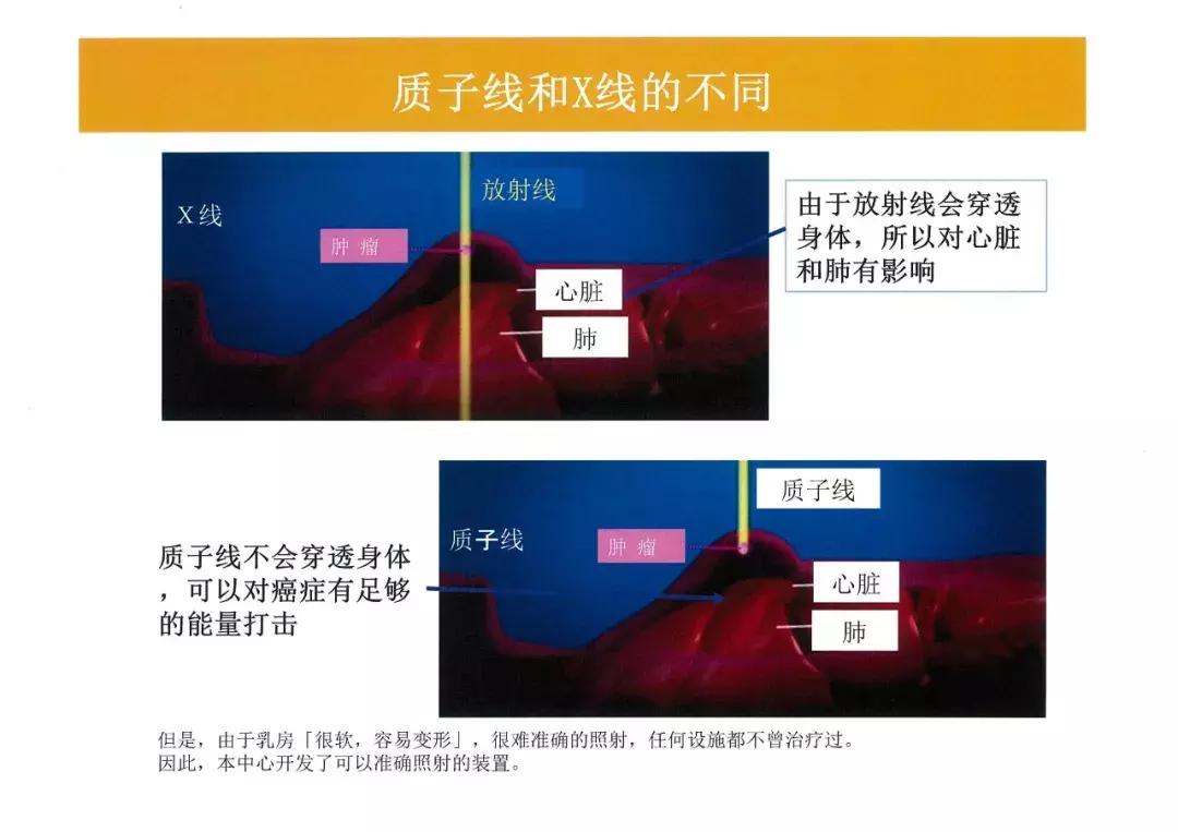 质子放疗中心安全距离,质子放疗介绍费
